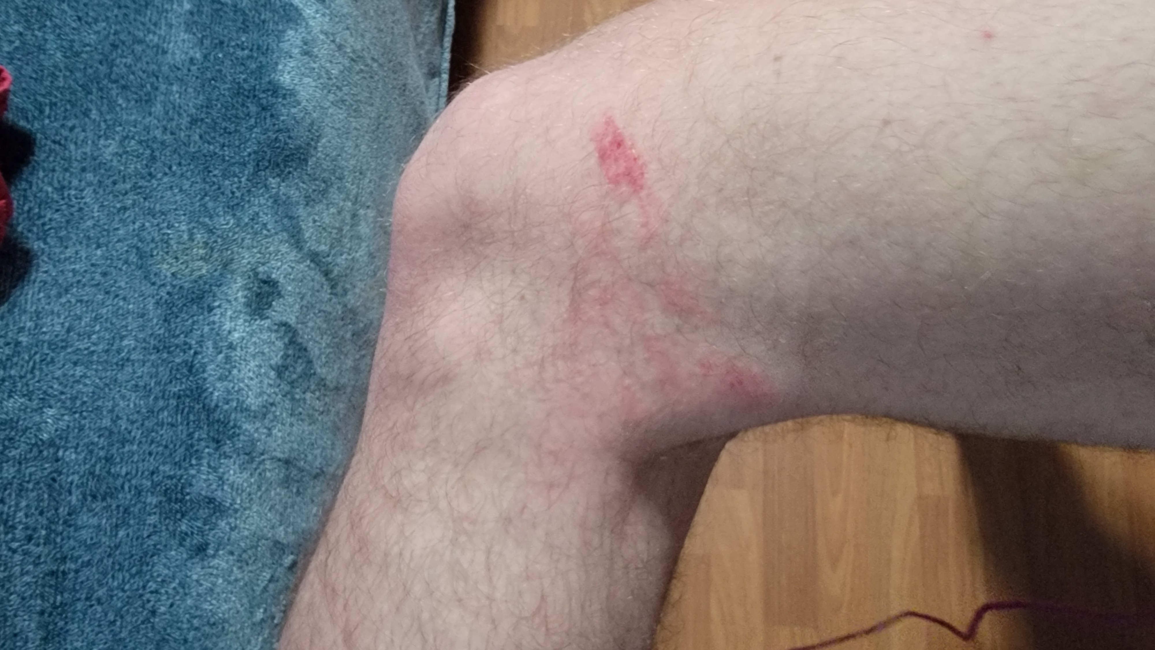 Day 1 after car hit – fresh bruises